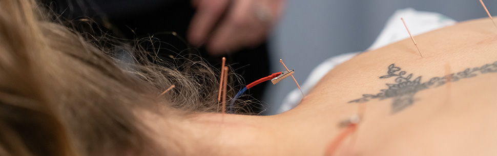 close up of acupuncture needles in back