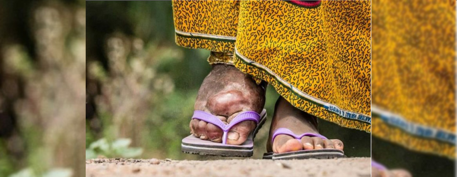 A foot in a flip-flop sandal has a large bulge on the top, caused by elephantiasis.